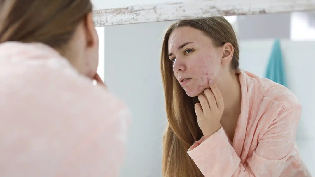 1. Les causes de l'acné et comment les éviter ?