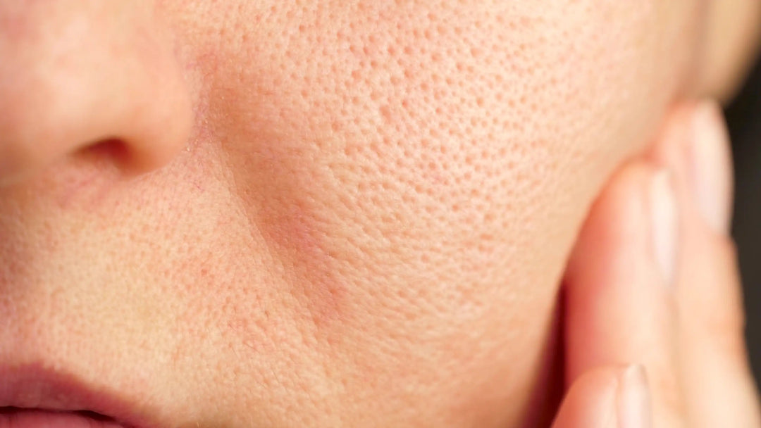 Perfectionner Votre Peau : Stratégies Efficaces pour Diminuer les Pores Dilatés